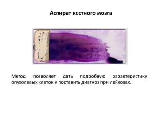 Аспират костного мозга
Метод позволяет дать подробную характеристику
опухолевых клеток и поставить диагноз при лейкозах.
 