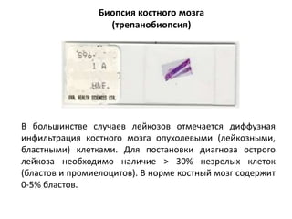 Биопсия костного мозга
(трепанобиопсия)
В большинстве случаев лейкозов отмечается диффузная
инфильтрация костного мозга опухолевыми (лейкозными,
бластными) клетками. Для постановки диагноза острого
лейкоза необходимо наличие > 30% незрелых клеток
(бластов и промиелоцитов). В норме костный мозг содержит
0-5% бластов.
 