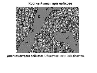 Костный мозг при лейкозе
Диагноз острого лейкоза: Обнаружение > 30% бластов.
 