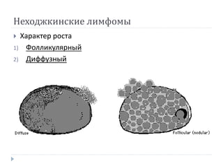Неходжкинские лимфомы
 Характер роста
1) Фолликулярный
2) Диффузный
 