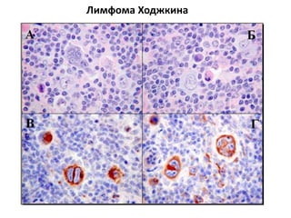 Лимфома Ходжкина
 
