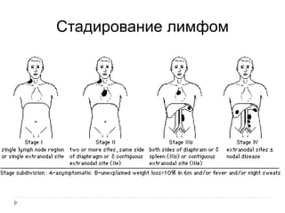 Стадирование лимфом
 