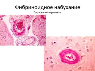 Фибриноидное набухание
Окраска азокармином
 