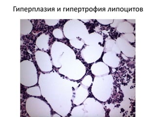 Гиперплазия и гипертрофия липоцитов
 