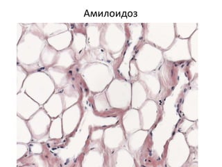 Амилоидоз
 
