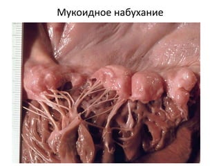 Мукоидное набухание
 