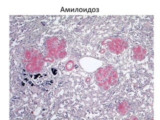 Амилоидоз
 