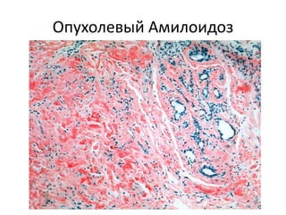 Опухолевый Амилоидоз
 