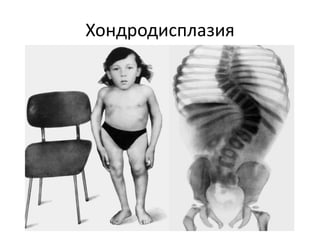 Хондродисплазия
 