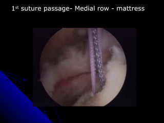 1st
suture passage- Medial row - mattress
 