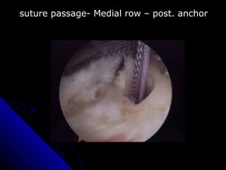 suture passage- Medial row – post. anchor
 