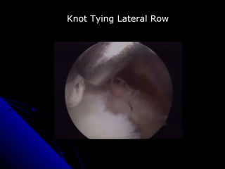 Knot Tying Lateral Row
 