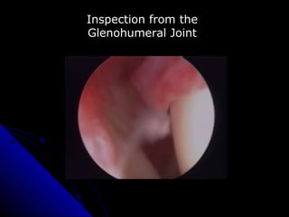 Inspection from the
Glenohumeral Joint
 