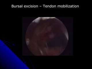 Bursal excision – Tendon mobilization
 