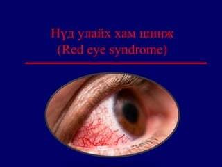Нүд улайх хам шинж
(Red eye syndrome)
 