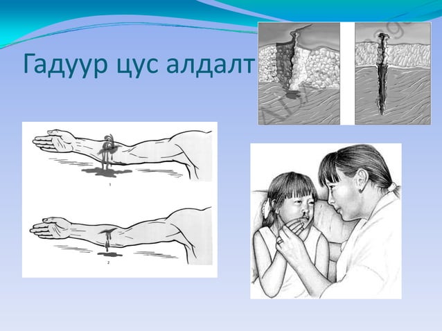 цус алдалтын үед авах арга хэмжээ