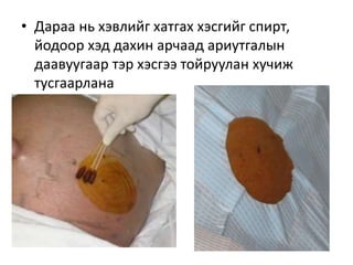 хэвлийн хөндийд хатгалт хийх | PPT