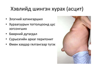 хэвлийн хөндийд хатгалт хийх | PPT