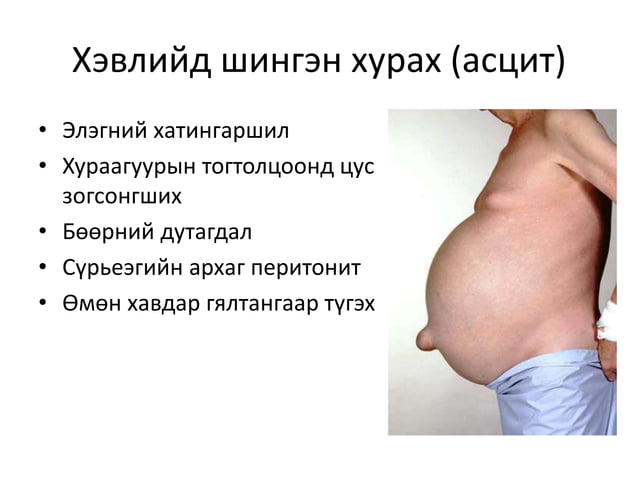хэвлийн хөндийд хатгалт хийх