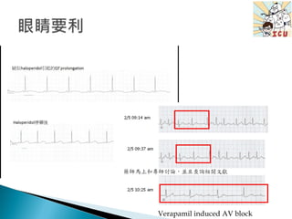 Verapamil induced AV block
 