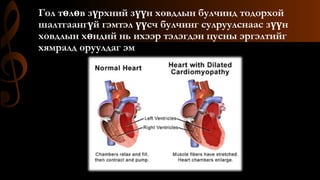 Гол төлөв зүрхний зүүн ховдлын булчинд тодорхой
шалтгаангүй гэмтэл үүсч булчинг сулруулснаас зүүн
ховдлын хөндий нь ихээр тэлэгдэн цусны эргэлтийг
хямралд оруулдаг эм
 
