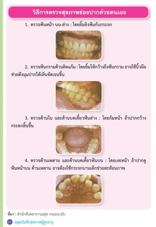 สมุดบันทึกสุขภาพผู้สูงอายุ
	 1.	ตรวจฟันหน้า บน-ล่าง : โดยยิ้มยิงฟันกับกระจก
	 2.	ตรวจฟันกรามด้านติดแก้ม : โดยยิ้มให้กว้างถึงฟันกราม อาจใช้นิ้วมือ
ช่วยดึงมุมปากให้เห็นชัดเจนขึ้น
	 3.	ตรวจด้านใน และด้านบดเคี้ยวฟันล่าง : โดยก้มหน้า อ้าปากกว้าง
กระดกลิ้นขึ้น
	 4.	ตรวจด้านเพดาน และด้านบดเคี้ยวฟันบน : โดยเงยหน้า อ้าปากดู
ฟันหน้าบน ด้านเพดาน อาจต้องใช้กระจกบานเล็กช่วยสะท้อนภาพ
วิธีการตรวจสุขภาพช่องปากด้วยตนเอง
ที่มา : ส�ำนักทันตสาธารณสุข กรมอนามัย
21
 