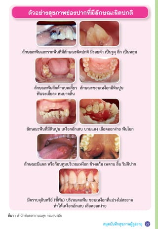 สมุดบันทึกสุขภาพผู้สูงอายุ
ตัวอย่างสุขภาพช่องปากที่มีลักษณะผิดปกติ
ลักษณะฟันและรากฟันที่มีลักษณะผิดปกติ มีรอยด�ำ เป็นรูผุ สึก เป็นหลุม
ที่มา : ส�ำนักทันตสาธารณสุข กรมอนามัย
มีคราบจุลินทรีย์ (ขี้ฟัน) บริเวณคอฟัน ขอบเหงือกที่แปรงไม่สะอาด
ท�ำให้เหงือกอักเสบ เลือดออกง่าย
ลักษณะมีแผล หรือก้อนทูมบริเวณเหงือก ข้างแก้ม เพดาน ลิ้น ริมฝีปาก
ลักษณะฟันที่มีหินปูน เหงือกอักเสบ บวมแดง เลือดออกง่าย ฟันโยก
ลักษณะขอบเหงือกมีหินปูนลักษณะฟันสึกด้านบดเคี้ยว
ฟันจะเตี้ยลง คมบาดลิ้น
22
 