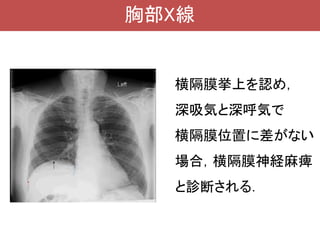 横隔膜筋力低下 | PDF