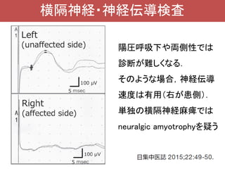 横隔膜筋力低下 | PDF