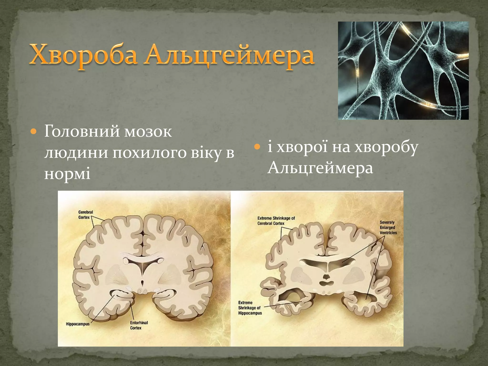  Головний мозок
людини похилого віку в
нормі
 і хворої на хворобу
Альцгеймера
 