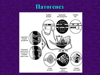 ПатогенезПатогенез
 