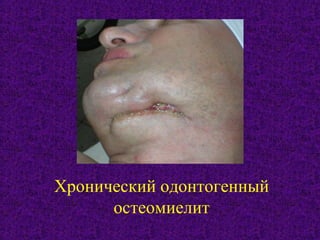 Хронический одонтогенный
остеомиелит
 