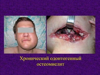Хронический одонтогенный
остеомиелит
 