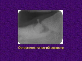 Остеомиелитический секвестр
 