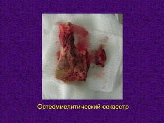 Остеомиелитический секвестр
 