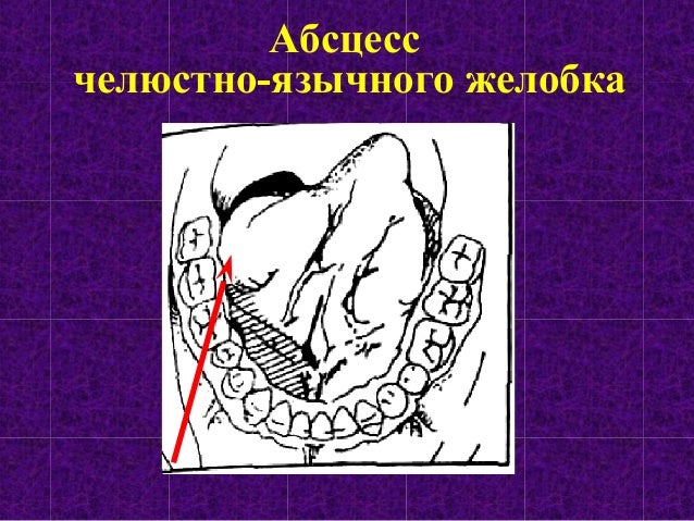 Абсцессы локализованные в полости рта: этиология, патогенез, пути рас…
