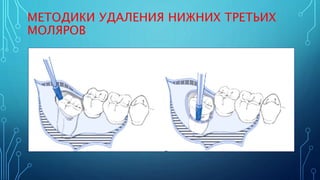 операция атипичного удаления зуба | PPT