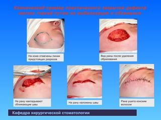 Клинический пример пластического закрытия дефекта
мягких тканей путем их мобилизации и сближения
Кафедра хирургической стоматологии
На коже отмечены линии
предстоящих разрезов
Вид раны после удаления
образования
На рану накладывают
сближающие швы
Рана ушита конским
волосом
На рану наложены швы
 
