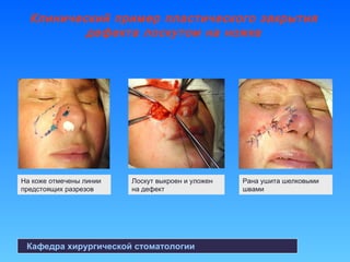 Кафедра хирургической стоматологии
На коже отмечены линии
предстоящих разрезов
Лоскут выкроен и уложен
на дефект
Рана ушита шелковыми
швами
Клинический пример пластического закрытия
дефекта лоскутом на ножке
 