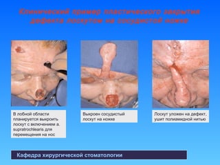 Кафедра хирургической стоматологии
Клинический пример пластического закрытия
дефекта лоскутом на сосудистой ножке
В лобной области
планируется выкроить
лоскут с включением a.
supratrochlearis для
перемещения на нос
Выкроен сосудистый
лоскут на ножке
Лоскут уложен на дефект,
ушит полиамидной нитью
 
