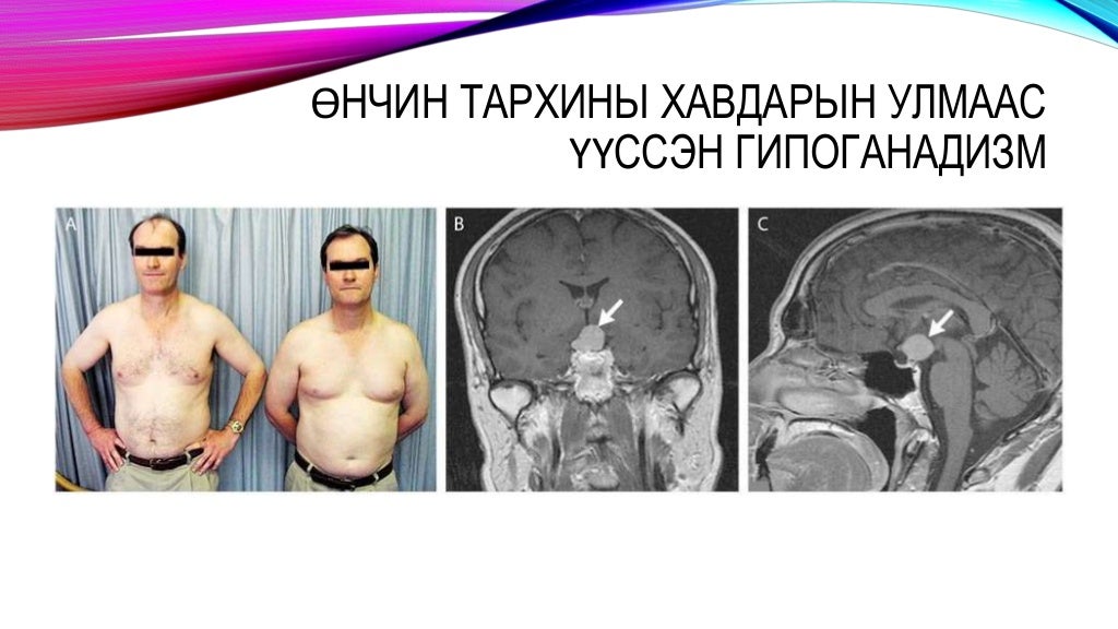 бэлгийн булчирхайн эмгэгүүд