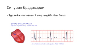 синусын брадикарди | PPT