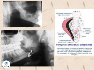 Complex Odontogenic Infections