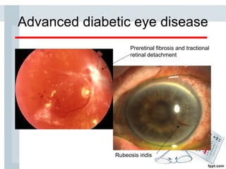 Diabetic retinopathy | PPT