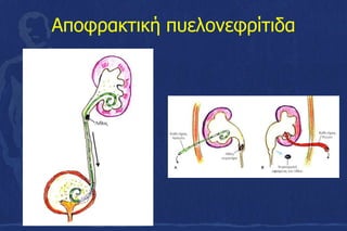 Αποφρακτική πυελονεφρίτιδα
 