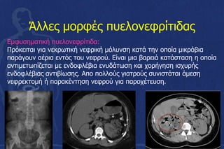 Άλλες μορφές πυελονεφρίτιδας
Εμφυσηματική πυελονεφρίτιδα:
Πρόκειται για νεκρωτική νεφρική μόλυνση κατά την οποία μικρόβια
παράγουν αέρια εντός του νεφρού. Είναι μια βαρειά κατάσταση η οποία
αντιμετωπίζεται με ενδοφλέβια ενυδάτωση και χορήγηση ισχυρής
ενδοφλέβιας αντιβίωσης. Απο πολλούς γιατρούς συνιστάται άμεση
νεφρεκτομή ή παρακέντηση νεφρού για παροχέτευση.
 