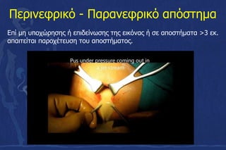 Περινεφρικό - Παρανεφρικό απόστημα
Επί μη υποχώρησης ή επιδείνωσης της εικόνας ή σε αποστήματα >3 εκ.
απαιτείται παροχέτευση του αποστήματος.
 