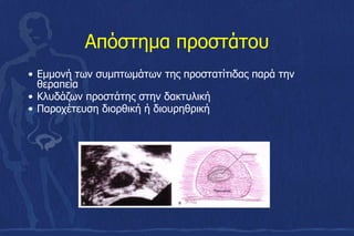 Απόστημα προστάτου
• Εμμονή των συμπτωμάτων της προστατίτιδας παρά την
θεραπεία
• Κλυδάζων προστάτης στην δακτυλική
• Παροχέτευση διορθική ή διουρηθρική
 