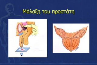Μάλαξη του προστάτη
 