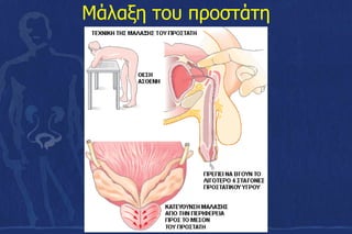 Μάλαξη του προστάτη
 